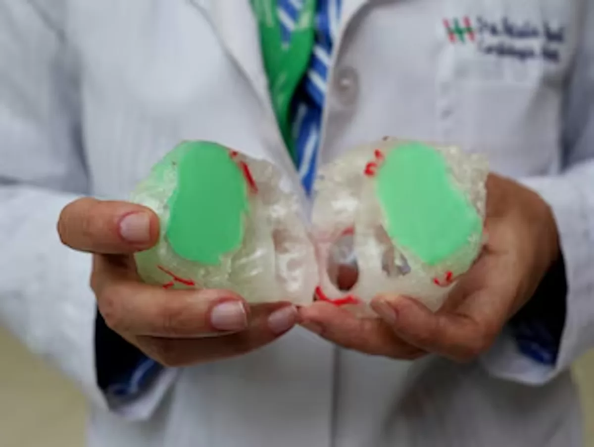 Un corazón en 3D ayudó a un niño con tumor