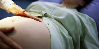 Nació bebé con microcefalia por un caso de zika autóctono