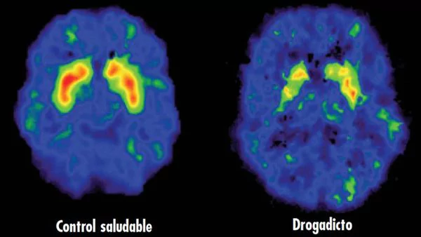 El cerebro adicto: cómo las drogas anulan las capacidades humanas