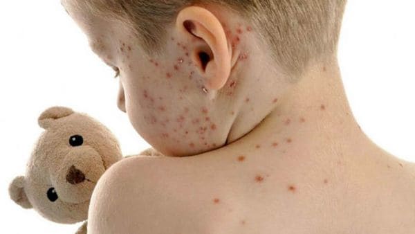 Alerta primavera: la aparición de enfermedades eruptivas en los más chicos