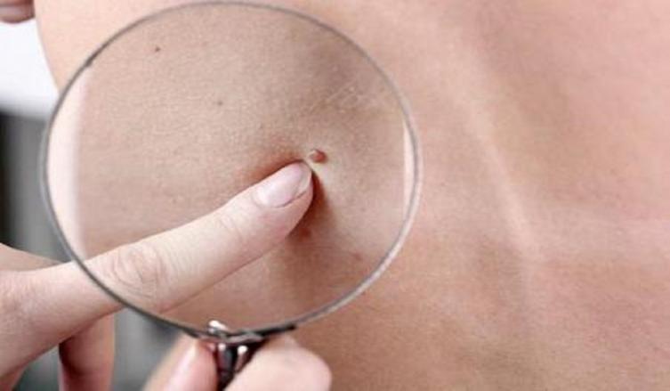La UBA inicia una campaña de detección de lunares para prevenir el cáncer de piel