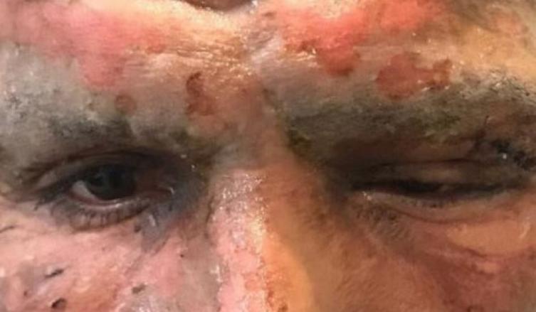 EL ROSTRO DE LUCAS VIATRI TRAS SUFRIR UN ACCIDENTE CON PIROTECNIA