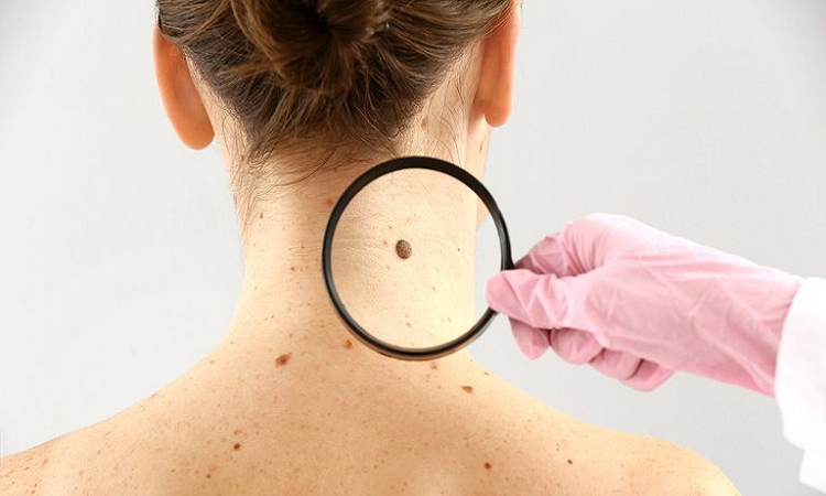 Cáncer de piel: guía para revisarse los lunares 