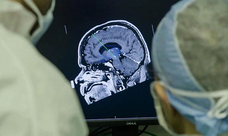 Un implante cerebral para tratar la depresión genera controversia 