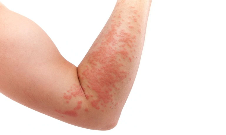 Psoriasis: mucho más que una enfermedad de la piel