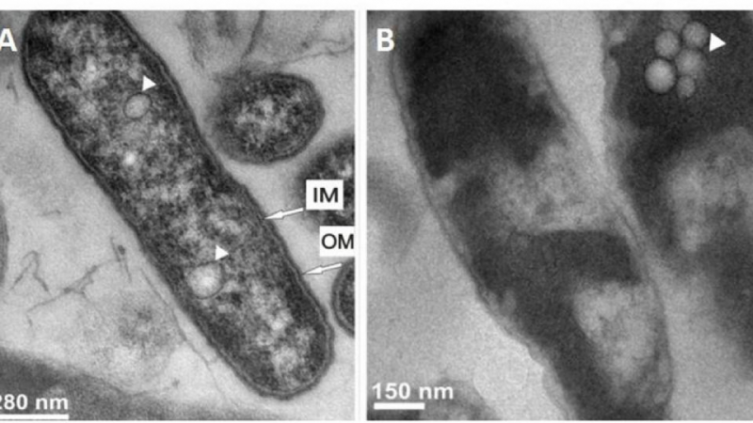 Neumonía en Tucumán: cuál es la bacteria que habría causado el brote 