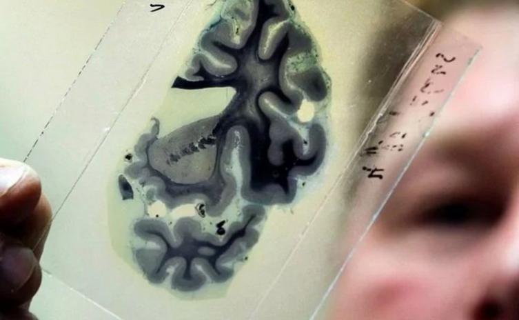Detectan un caso de Alzheimer en un joven de 19 años