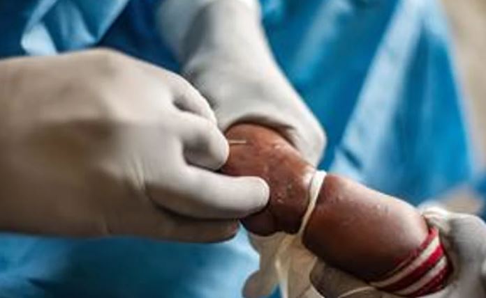 Alerta en China por la viruela del mono: implementan estrictos protocolos ante el crecimiento de casos
