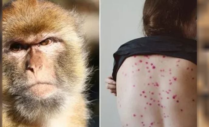 Ecuador identifica cinco casos de viruela del mono de cepa anterior