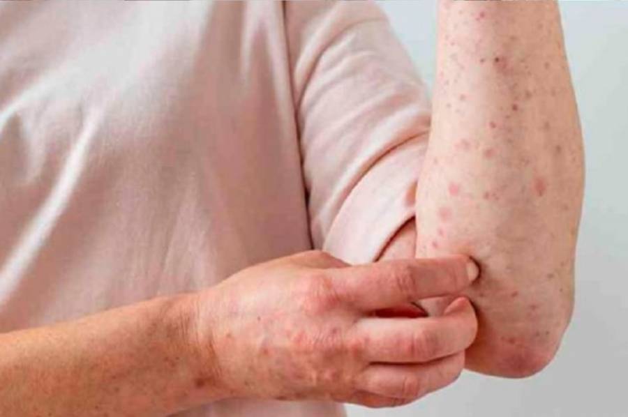 Se confirmó primer caso autóctono de viruela del mono en el país