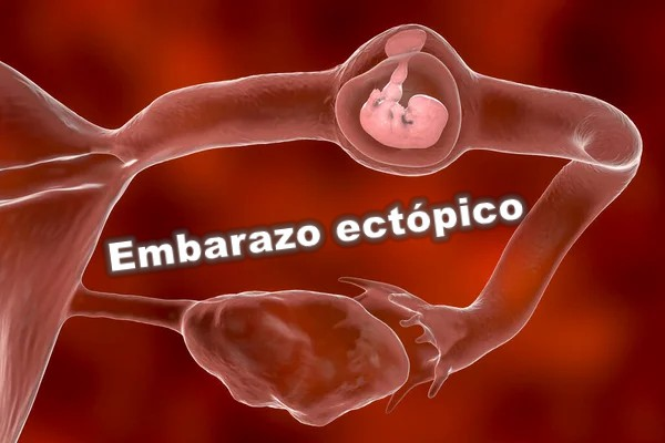 Por qué se produce un embarazo ectópico