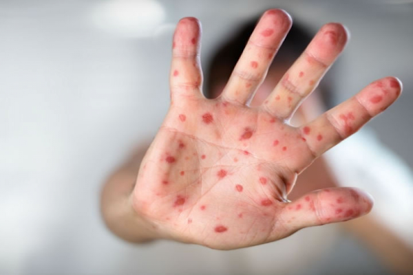 ¿Qué es el sarampión?: Cómo se contagia, síntomas 