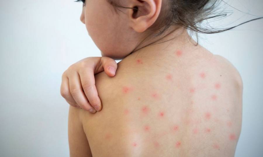 Se confirmó un caso de sarampión y hay alerta epidemiológica