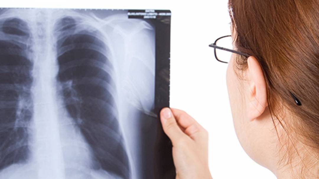 Santa Fe, entre las provincias con mayor aumento de casos de tuberculosis