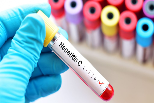 Hepatitis C: 8 de cada 10 personas aún no se trataron para curarse